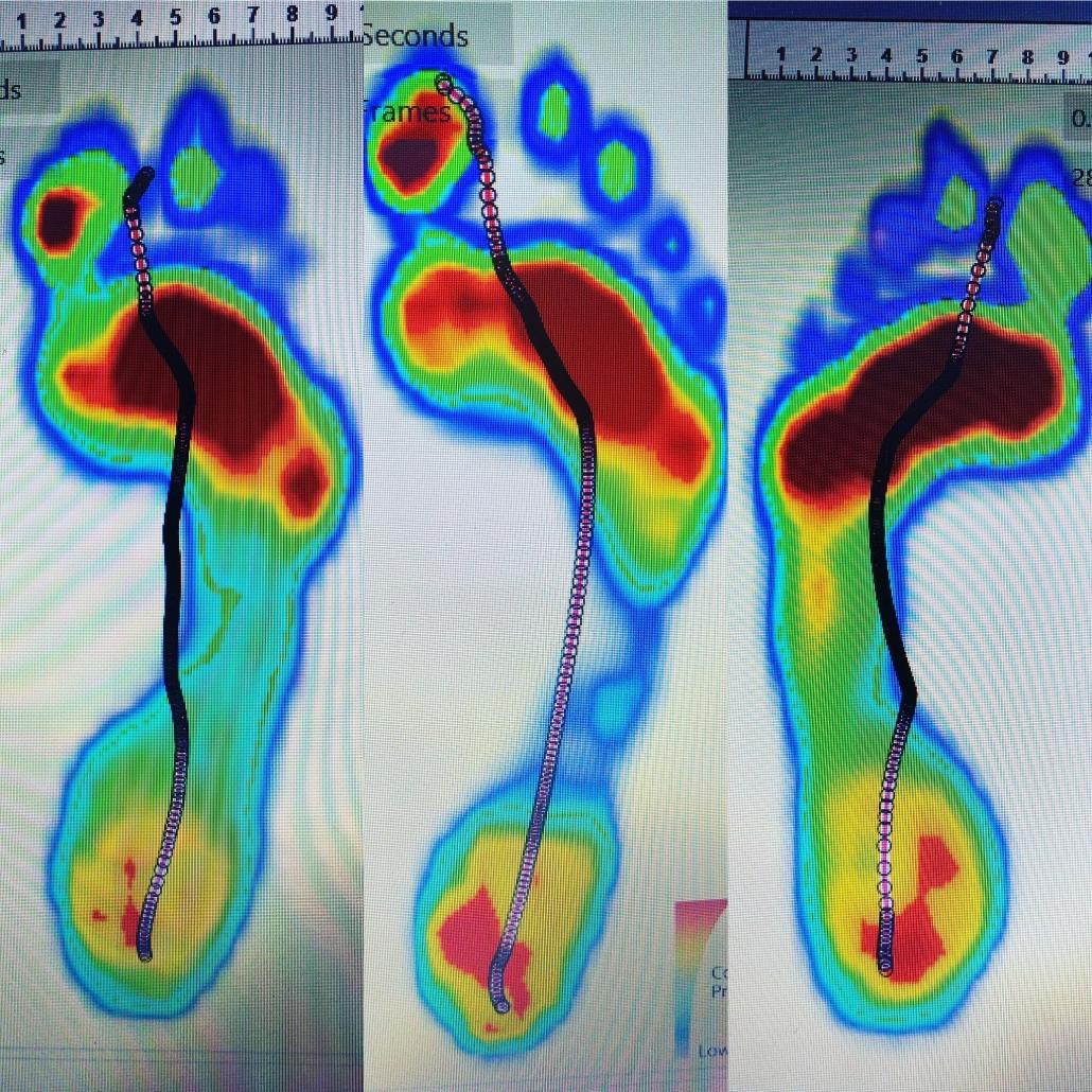 Diagnosis for knee pain with gait analysis