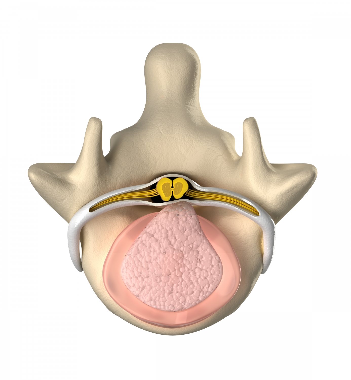 disc protrusion and lower back pain