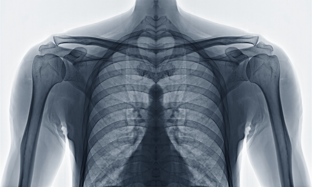 osteoporosis, shockwave therapy, bone growth