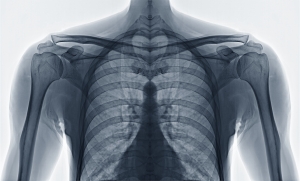 osteoporosis, shockwave therapy, bone growth