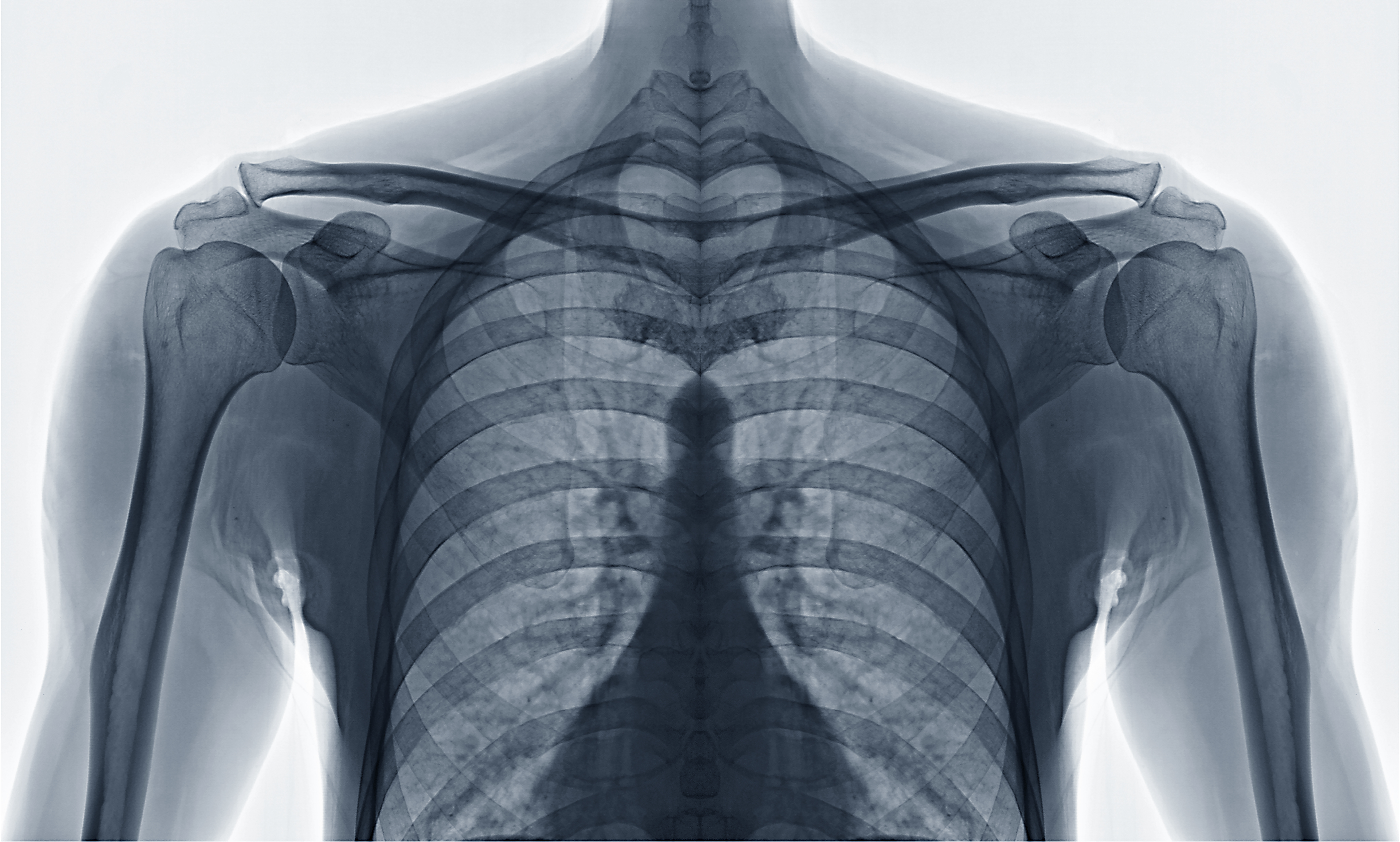 Read more about the article Rethinking Bone Health: Innovative Osteoporosis Treatment in Wellington