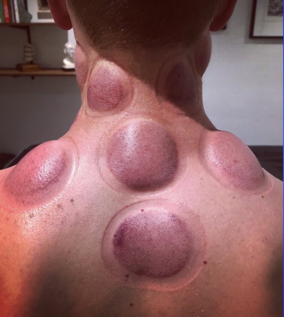 cupping neck pain & shoulder pain