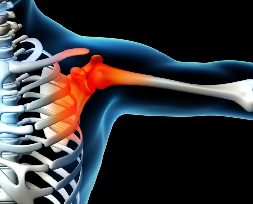 bursitis image indicating site of shoulder pain requiring treatment.