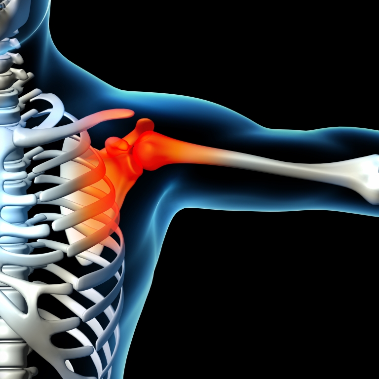 bursitis image indicating site of shoulder pain requiring treatment.