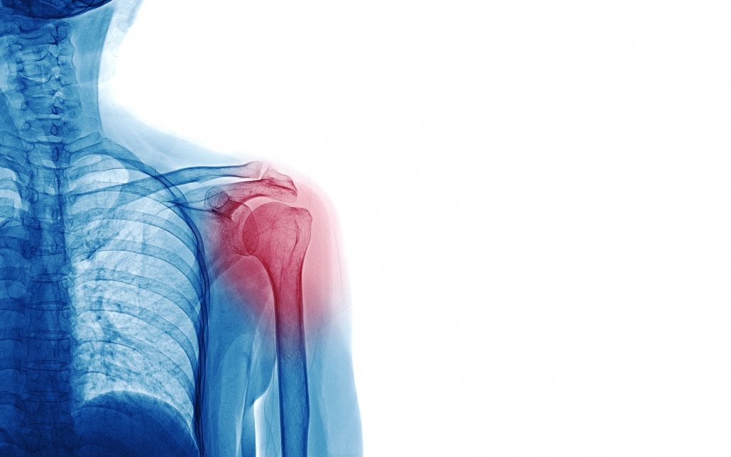 Image of the shoulder joint which is prone to bursitis pain.