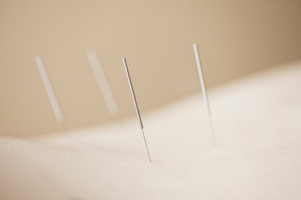 Needles like the ones that released this lady's sciatic pain