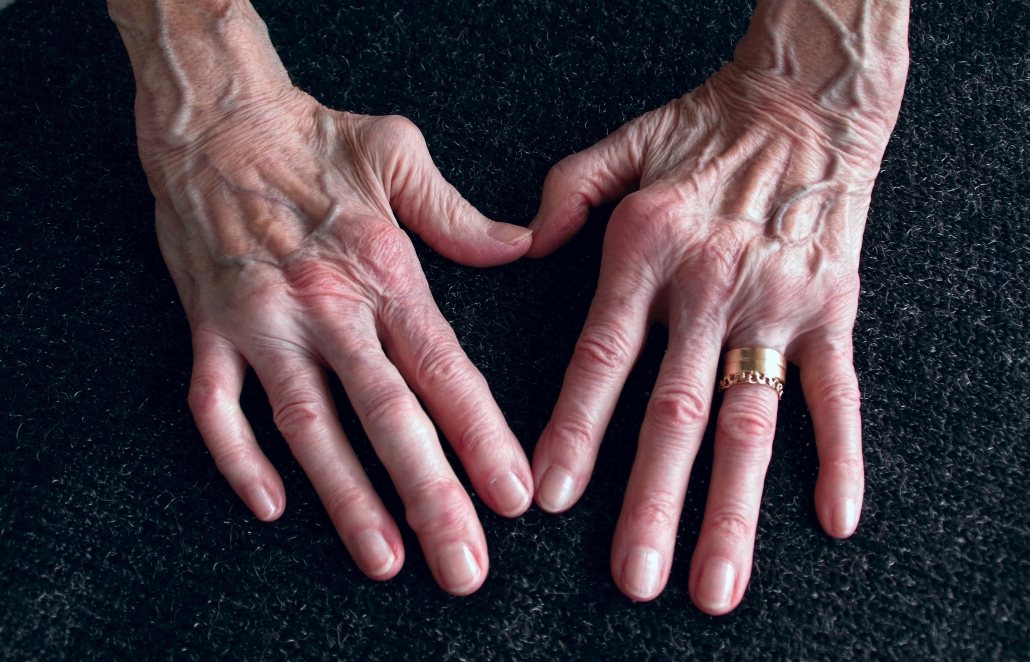 Injuries pain and degeneration illustration.