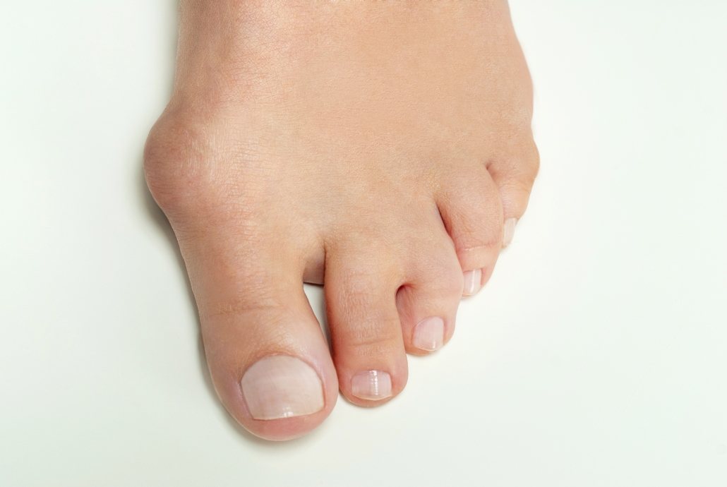 Picture of a bunion, education on the use of custom orthotics.